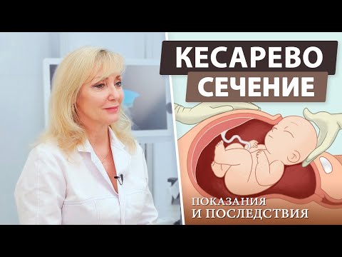 Видео: Кесарево сечение — что такое и когда назначается?