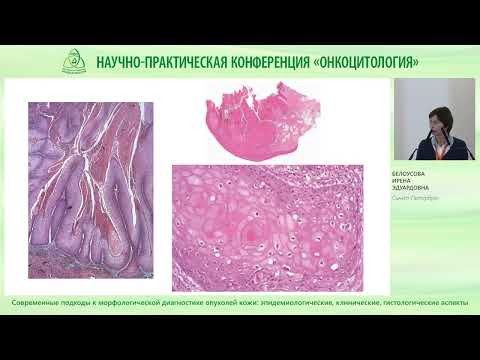 Видео: Современные подходы к морфологической диагностике опухолей кожи