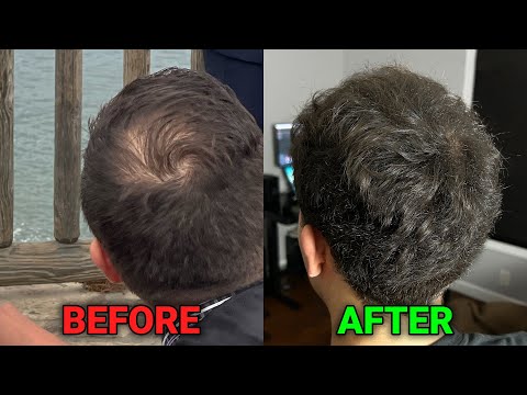 Видео: как я обратил облысение