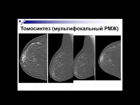 Видео: Чёрная А.В. «Диагностика рака плотной молочной железы»