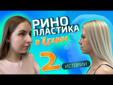 Видео: Ринопластика в Турции до и после. Результат огонь