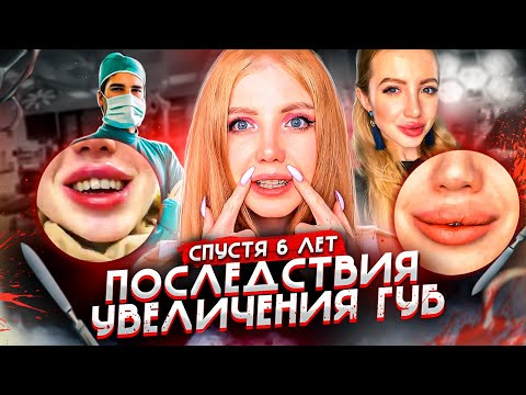 Видео: НЕ КОЛИТЕ ГУБЫ!!! ПОСЛЕДСТВИЯ УВЕЛИЧЕНИЯ ГУБ СПУСТЯ 6 ЛЕТ