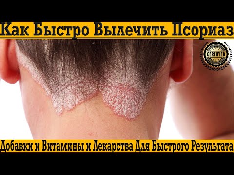 Видео: Как быстро и навсегда вылечить ПСОРИАЗ! Причины возникновения, витамины и лучшие лекарства!